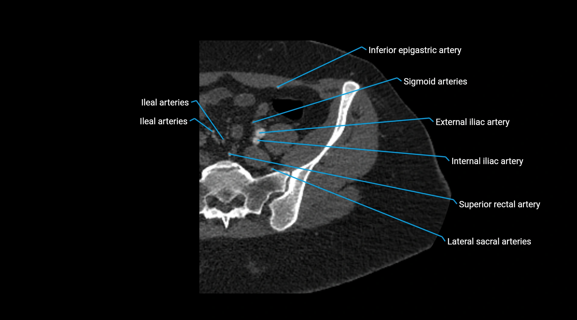 CTA lower limb cross sectional anatomy labelled image _22.webp